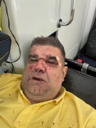 „РАКАТА ПУКНА НА ТРИ МЕСТА ОД ЈАЧИНАТА НА УДАРИТЕ“ – Саша Мирковиќ за ТЕШКИТЕ ТЕЛЕСНИ ПОВРЕДИ и ДЕТАЛИТЕ ОД ОПЕРАЦИЈАТА по обидот за убиство