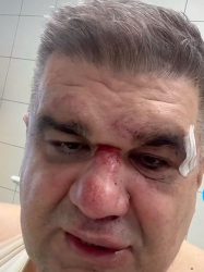 САША МИРКОВИЌ ГО ПОДГОТВУВААТ ЗА ОПЕРАЦИОНА САЛА ПО БРУТАЛНИОТ НАПАД И ОБИД ЗА УБИСТВО